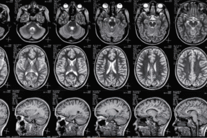 Failure to Monitor After Surgery